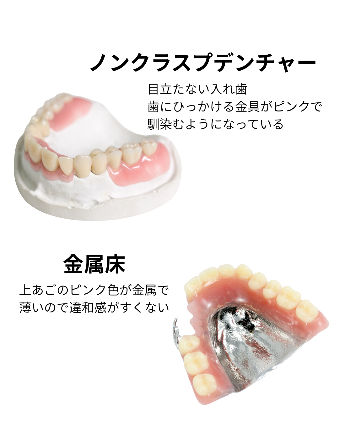 ノンクラスプデンチャー
